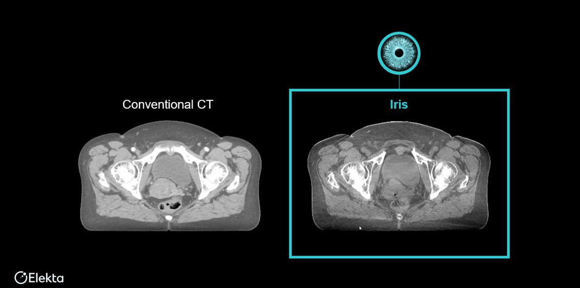 Iris高清晰CBCT影像与CT影像对比